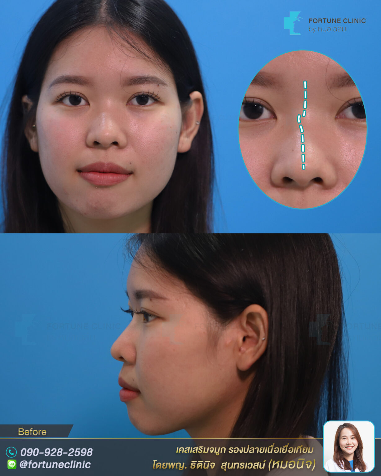 [หัวตาหัก/ฐานคด] เสริมจมุกครอบฐานที่คดเอียง โดยไม่ต้องตะไบฐาน ทรงสโลป